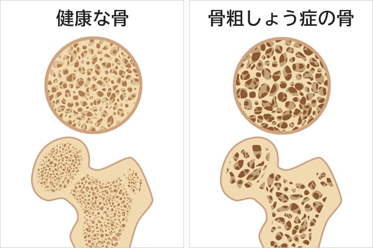 健康な骨と骨粗しょう症の骨