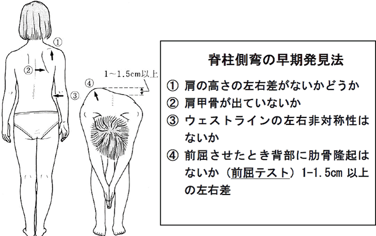 脊柱側彎の早期発見法　①肩の高さの左右さがないかどうか　②肩甲骨が出ていないか　➂ウェストラインの左右非対称性はないか　④前屈させたときはイブに肋骨隆起はないか(前屈テスト)1-1.5cm以上の左右差