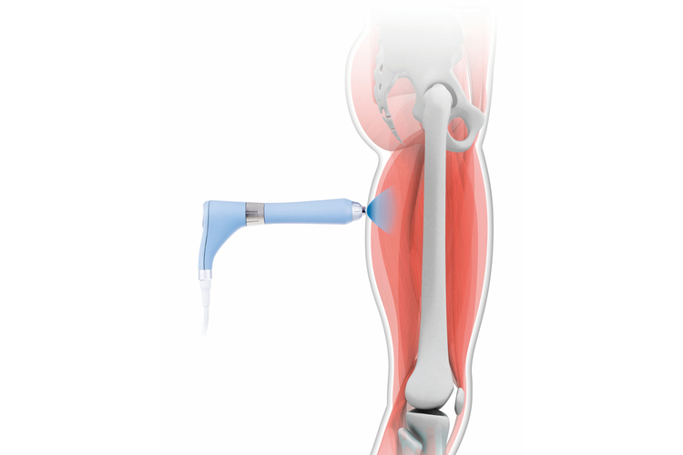 体外衝撃波治療のイメージ画像