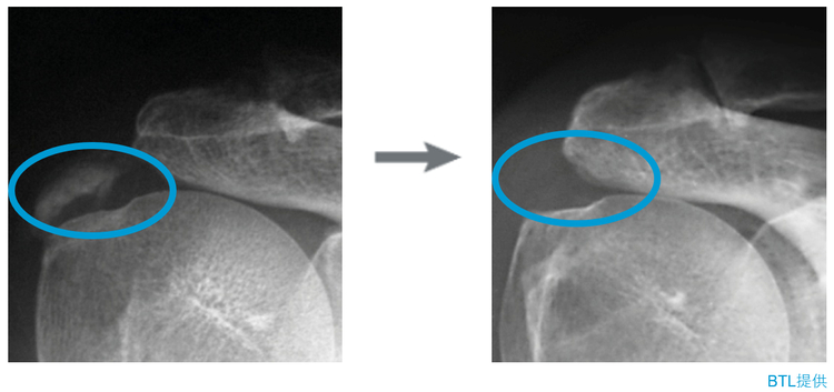 体外衝撃波治療のイメージ画像