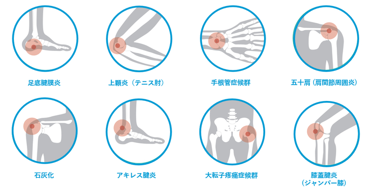 対象疾患のイメージ画像